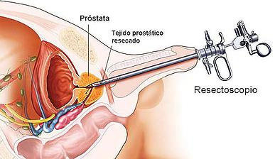 prostata_02